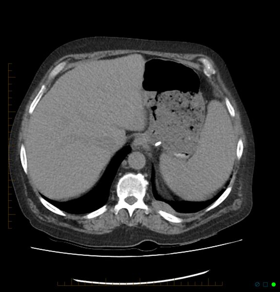 File:Acute renal failure post IV contrast injection- CT findings (Radiopaedia 47815-52557 Axial non-contrast 15).jpg