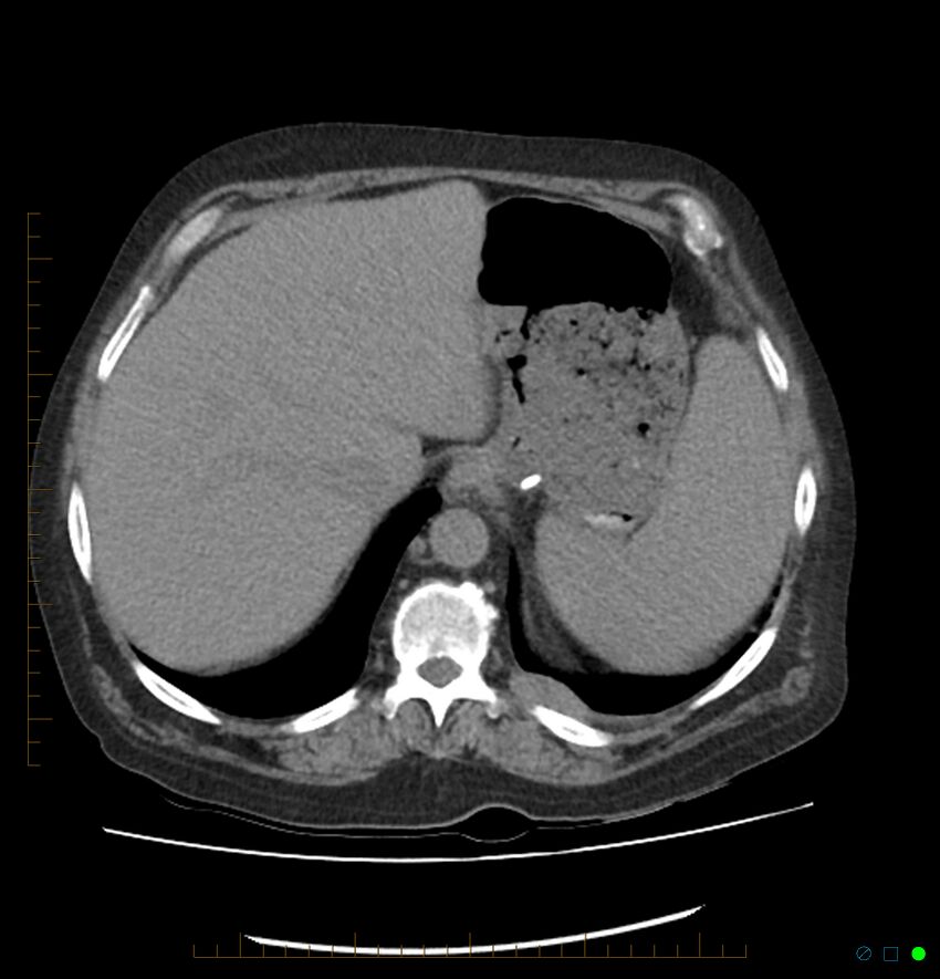 Acute renal failure post IV contrast injection- CT findings (Radiopaedia 47815-52557 Axial non-contrast 15).jpg