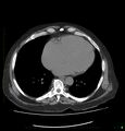 Acute renal failure post IV contrast injection- CT findings (Radiopaedia 47815-52559 Axial C+ portal venous phase 3).jpg