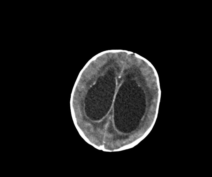 File:Acute ventriculitis (Radiopaedia 57502-64459 Axial +contrast 13).jpg