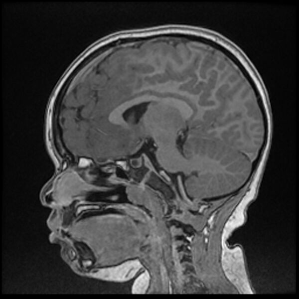 File:Adamantinomatous craniopharyngioma (Radiopaedia 77407-89529 Sagittal T1 C+ 61).jpg