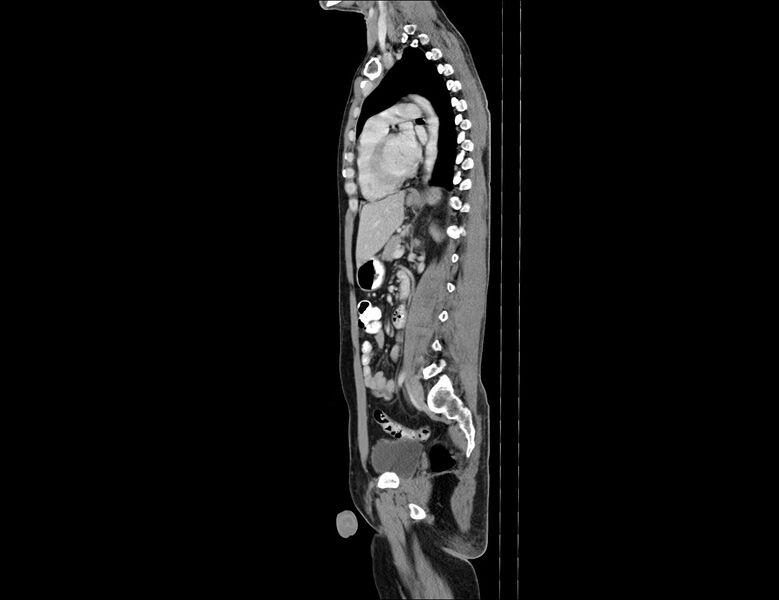 File:Addison disease (Radiopaedia 49318-54412 Sagittal C+ portal venous phase 28).jpg