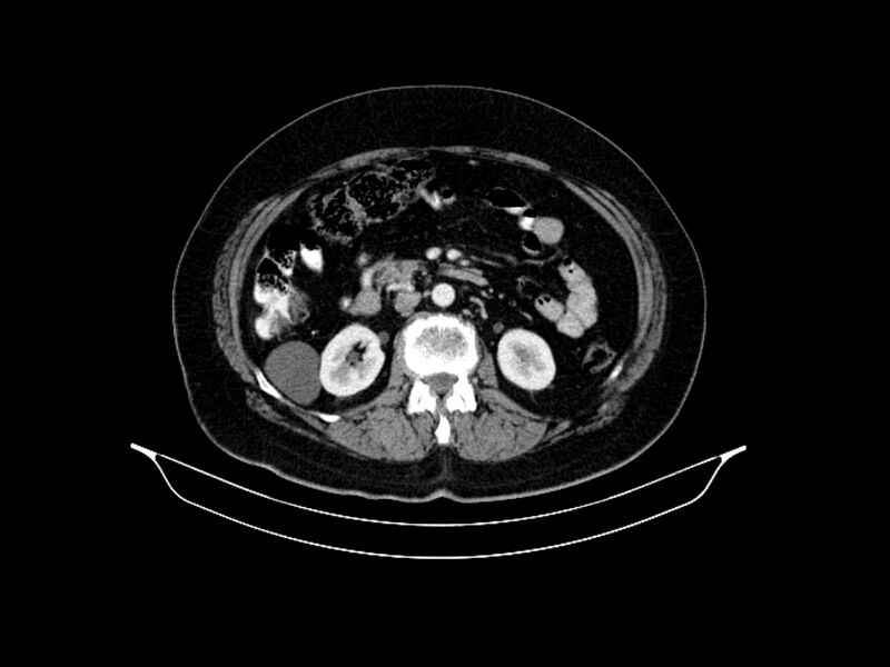 File:Adenocarcinoma of pancreas with hepatic metastasis (Radiopaedia 64332-73122 Axial C+ portal venous phase 47).jpg