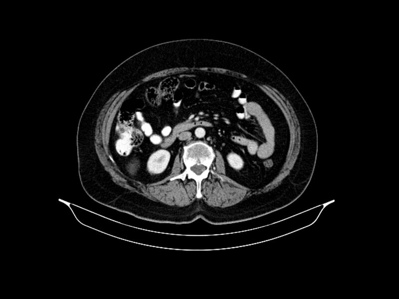 File:Adenocarcinoma of pancreas with hepatic metastasis (Radiopaedia 64332-73122 Axial C+ portal venous phase 50).jpg