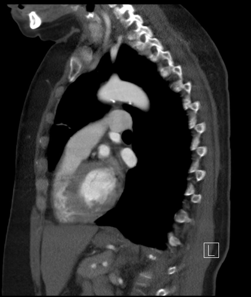 Adenocarcinoma of the lung (Radiopaedia 44205-47803 Sagittal C+ portal venous phase 24).jpg