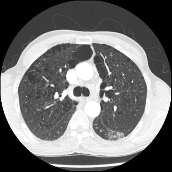 File:Adenocarcinoma of the lung - micropapillary predominant (Radiopaedia 42446-45563 C 10).jpg