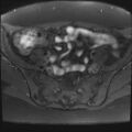 Adenomyosis and endometriotic cysts (Radiopaedia 82300-96367 Axial T1 fat sat 27).jpg