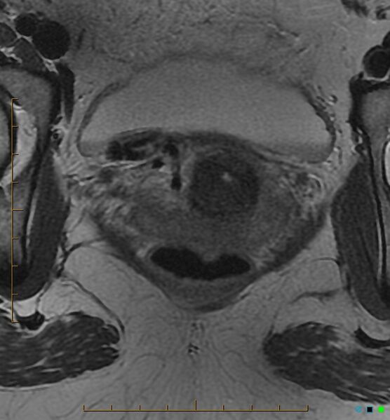 File:Adenomyosis uterus with hematometra (Radiopaedia 45779-50011 Axial T2 24).jpg