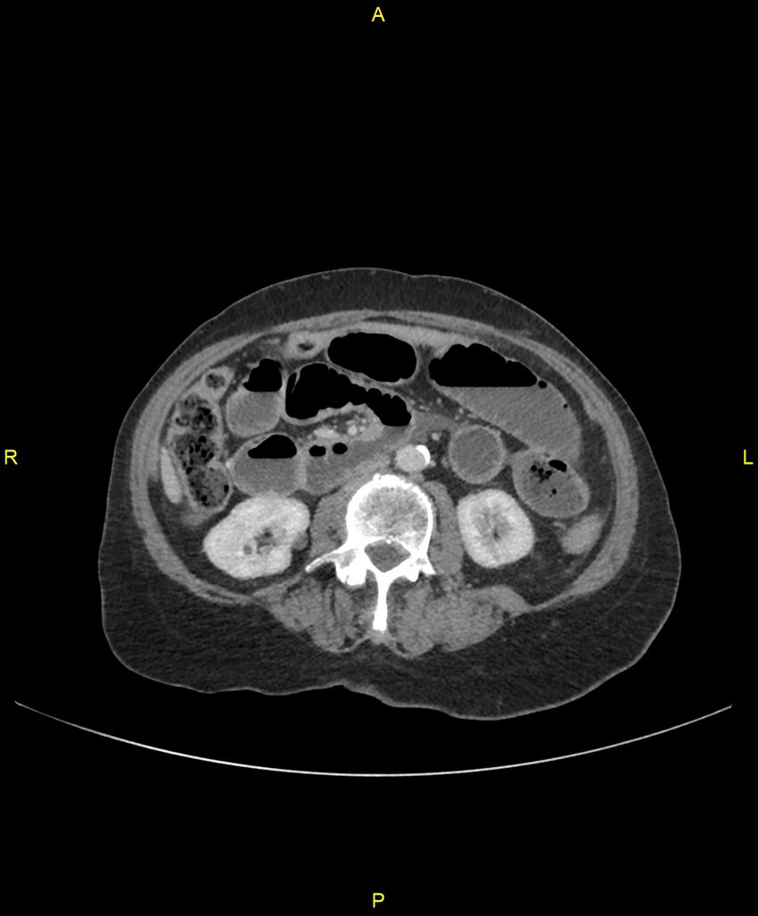 Adhesional small bowel obstruction (Radiopaedia 85402-101024 Axial C+ portal venous phase 134).jpg
