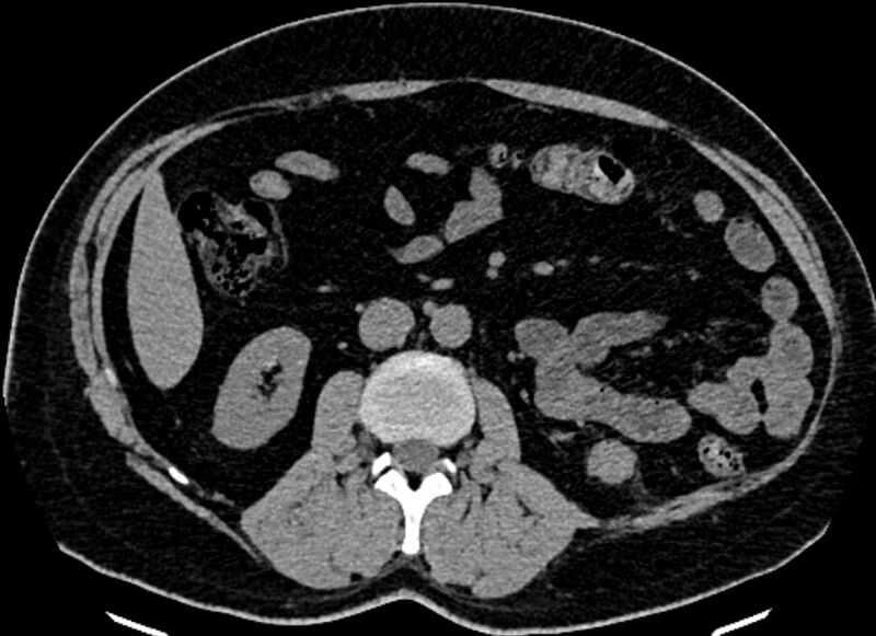 File:Adrenal metastases (Radiopaedia 73082-83791 Axial non-contrast 92).jpg