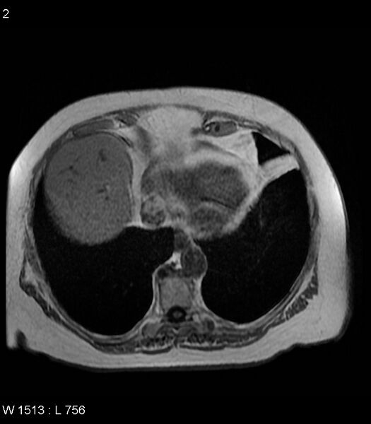 File:Adrenal myelolipoma (Radiopaedia 6765-7961 Axial T1 in-phase 2).jpg