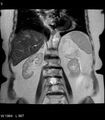 Adrenal myelolipoma (Radiopaedia 6765-7961 Coronal T2 5).jpg