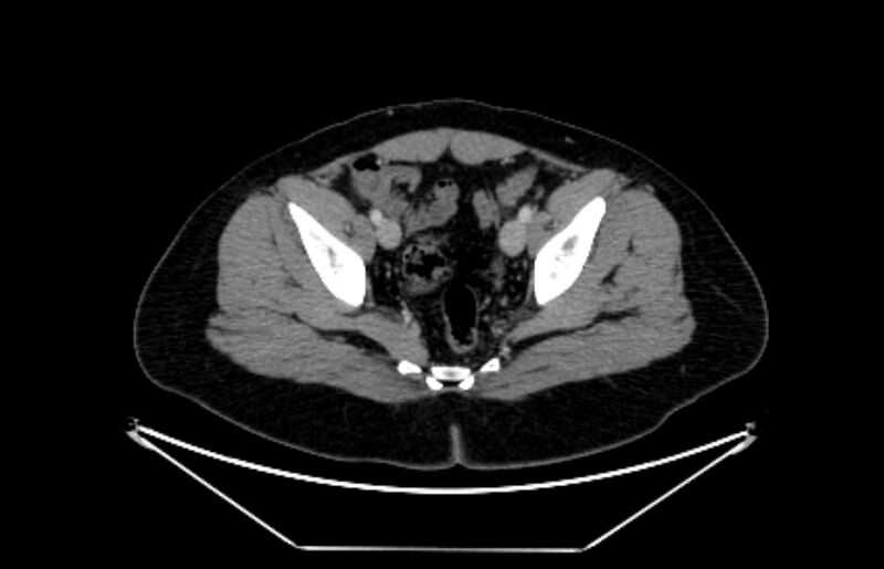 File:Adrenocortical carcinoma (Radiopaedia 80134-93438 Axial C+ portal venous phase 115).jpg