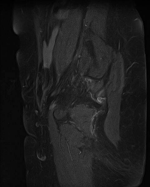 File:Adult granulosa cell tumor of the ovary (Radiopaedia 71581-81950 Sagittal T1 C+ fat sat 20).jpg
