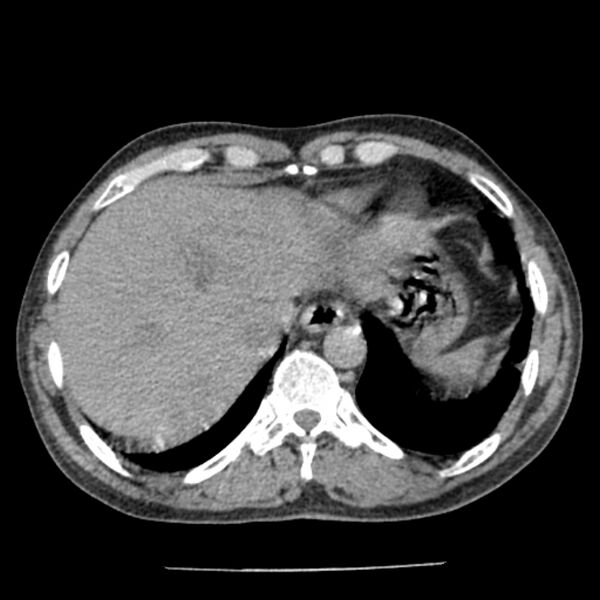 File:Airway foreign body in adult (Radiopaedia 85907-101779 Axial liver window 169).jpg