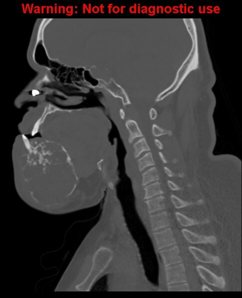 File:Ameloblastoma (Radiopaedia 33126-34164 Sagittal bone window 43).jpg