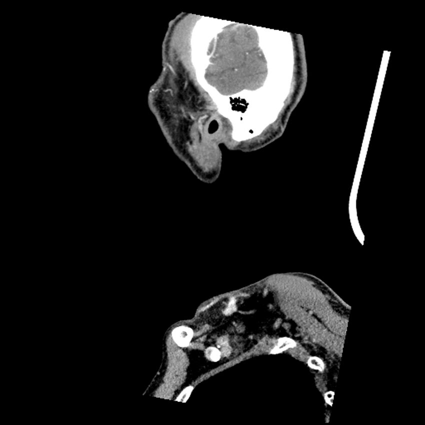 Anaplastic thyroid carcinoma (Radiopaedia 79087-92034 C 12).jpg