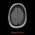 Anatomy- sulci of the brain (Radiopaedia 33834-34995 B 1).jpg