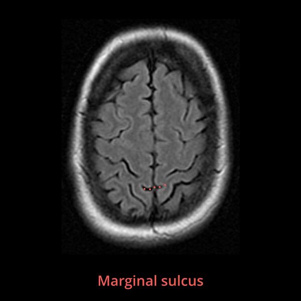 File:Anatomy- sulci of the brain (Radiopaedia 33834-34995 B 1).jpg