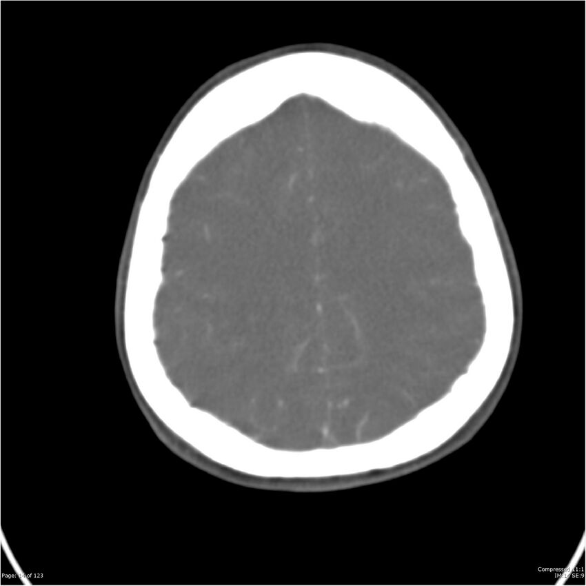 Aneurysmal subarachnoid hemorrhage and Moya Moya disease (Radiopaedia 34306-35593 Axial CT COW 14).jpg