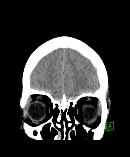 File:Angiomatous meningioma (Radiopaedia 79459-92578 Coronal non-contrast 8).jpg