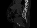 Ankylosing spondylitis (Radiopaedia 44609-48357 Sagittal bone window 48).jpg