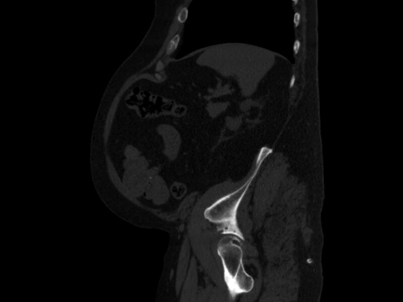 File:Ankylosing spondylitis (Radiopaedia 44609-48357 Sagittal bone window 92).jpg