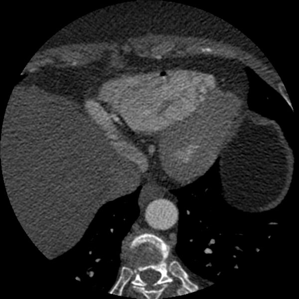 File:Anomalous origin of left circumflex artery from right coronary sinus (Radiopaedia 72563-83117 B 148).jpg