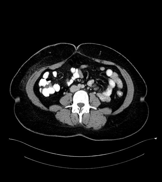 File:Anterior abdominal wall CSF pseudocyst (CSFoma) (Radiopaedia 79453-92571 A 54).jpg