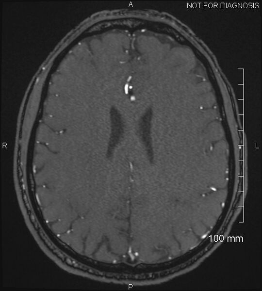 File:Anterior cerebral artery aneurysm (Radiopaedia 80683-94127 Axial MRA 166).jpg