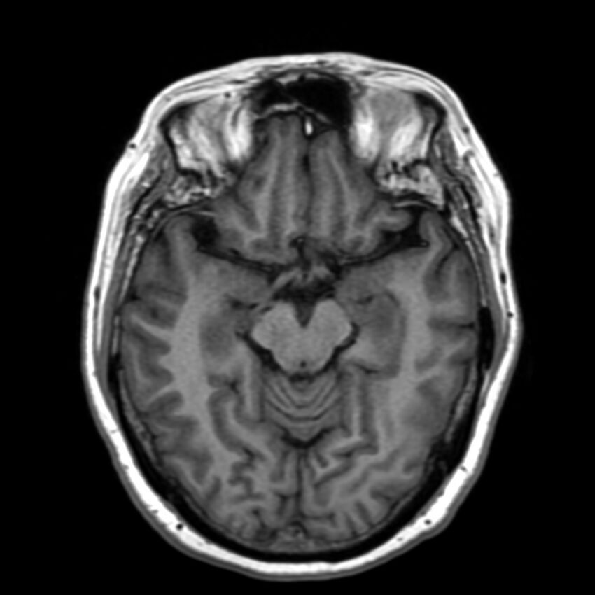 Anti-MOG encephalomyelitis (Radiopaedia 73831-84646 Axial T1 21).jpg