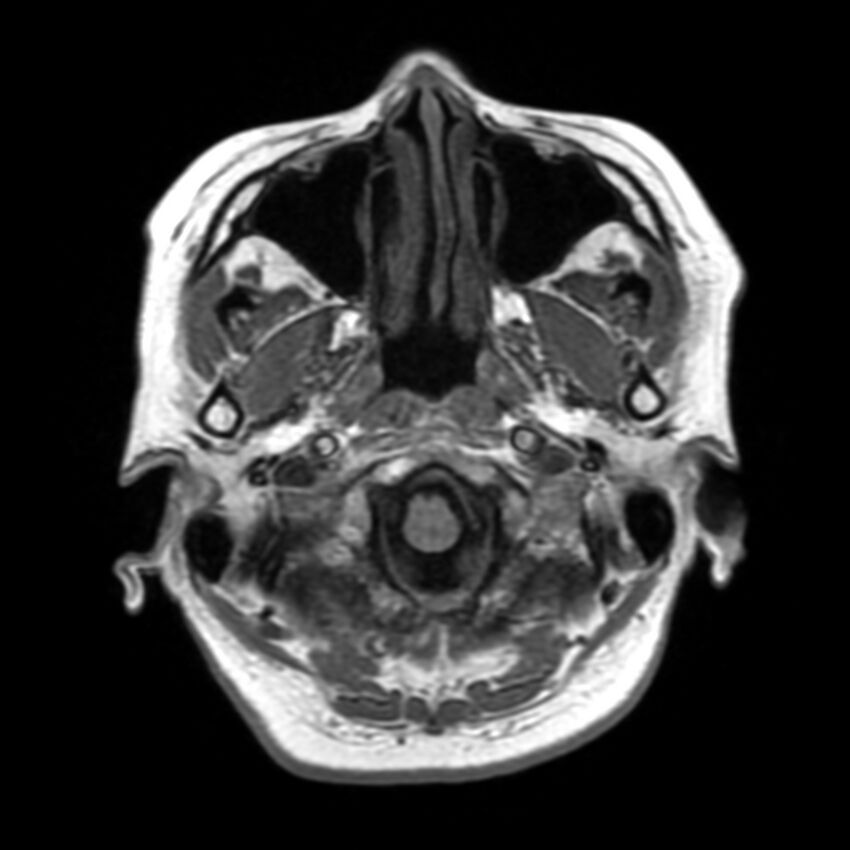 Anti-MOG encephalomyelitis (Radiopaedia 73831-84646 Axial T1 7).jpg