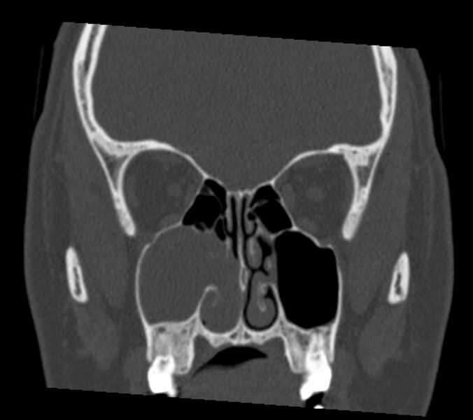 File:Antrochoanal polyp (Radiopaedia 21894-21868 Coronal bone window 16).jpg