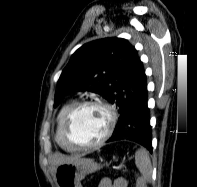 File:Aortic dissection - Stanford type A (Radiopaedia 29247-29659 C 6).jpg