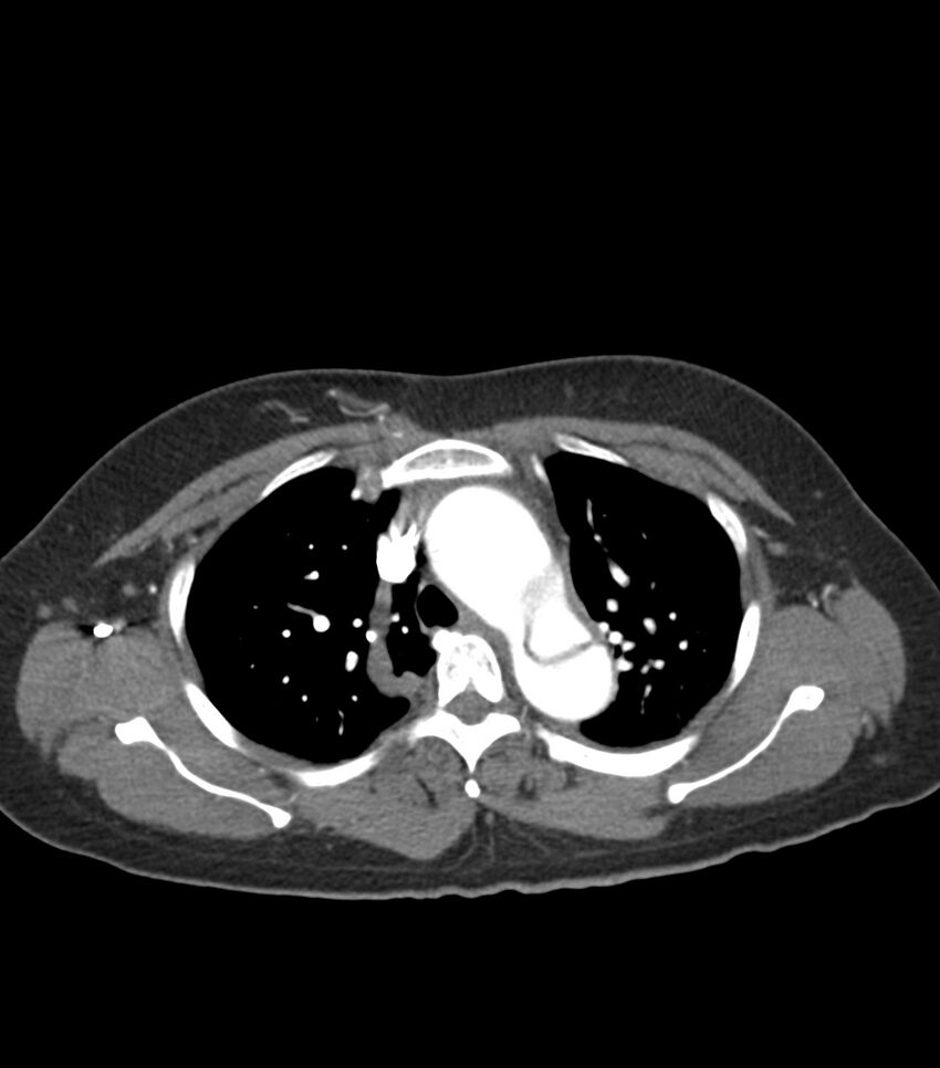Aortic dissection with renal ischemia (Radiopaedia 76573-88338 A 16).jpg