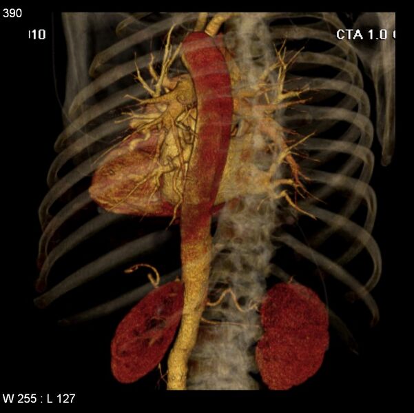 File:Aortic dissection with rupture into pericardium (Radiopaedia 12384-12647 C+ arterial phase 22).jpg