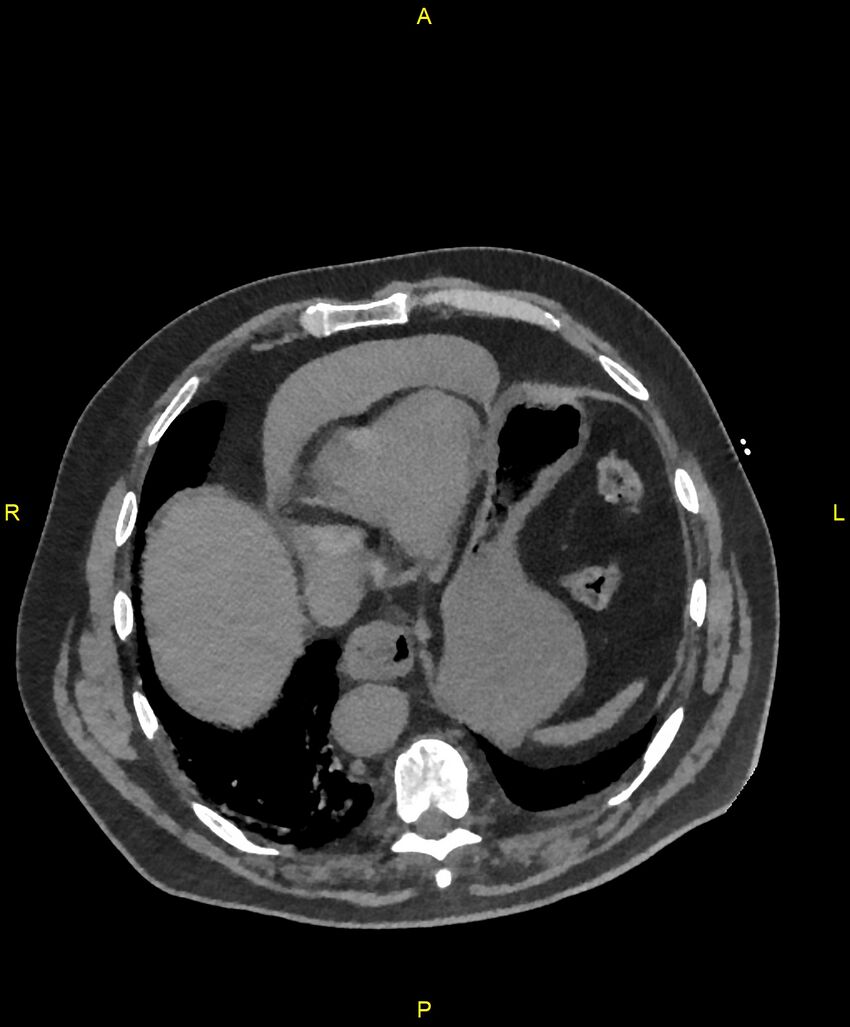 Aortic rupture (Radiopaedia 88822-105594 Axial non-contrast 181).jpg