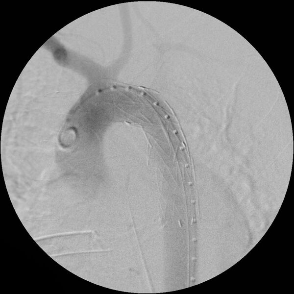 File:Aortic transection and subclavian steal (Radiopaedia 8711-9517 Stent 6).jpg