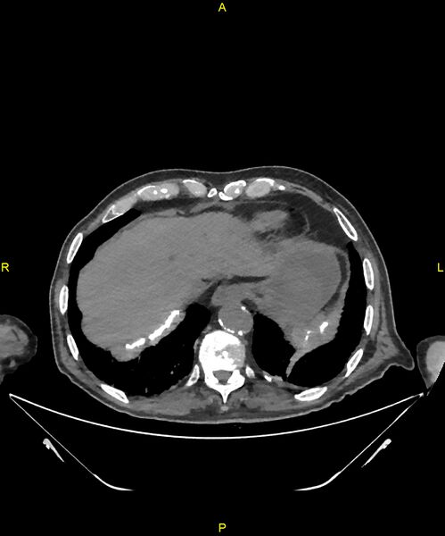 File:Aortoenteric fistula (Radiopaedia 84308-99603 Axial non-contrast 23).jpg