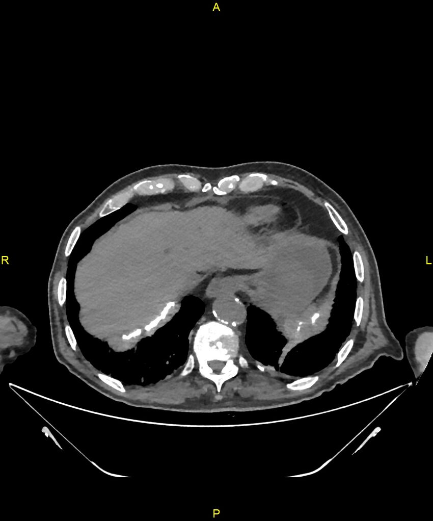 Aortoenteric fistula (Radiopaedia 84308-99603 Axial non-contrast 23).jpg