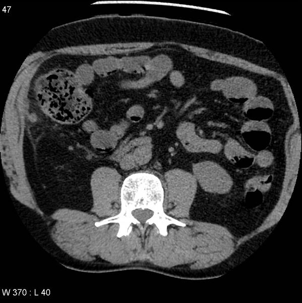 File:Appendicitis (Radiopaedia 12510-12733 Axial non-contrast 14).jpg