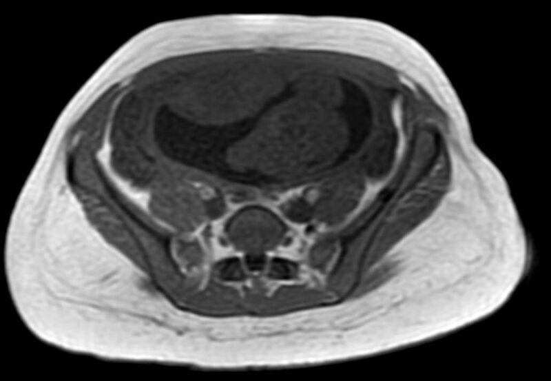 File:Appendicitis in gravida (MRI) (Radiopaedia 89433-106395 Axial T1 in-phase 48).jpg