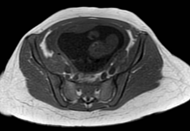 File:Appendicitis in gravida (MRI) (Radiopaedia 89433-106395 Axial T1 in-phase 53).jpg