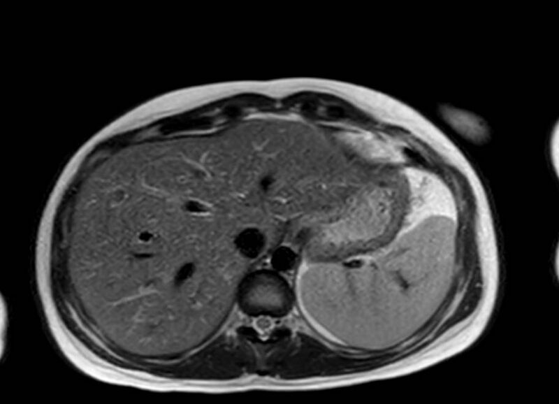 File:Appendicitis in gravida (MRI) (Radiopaedia 89433-106395 Axial T2 8).jpg