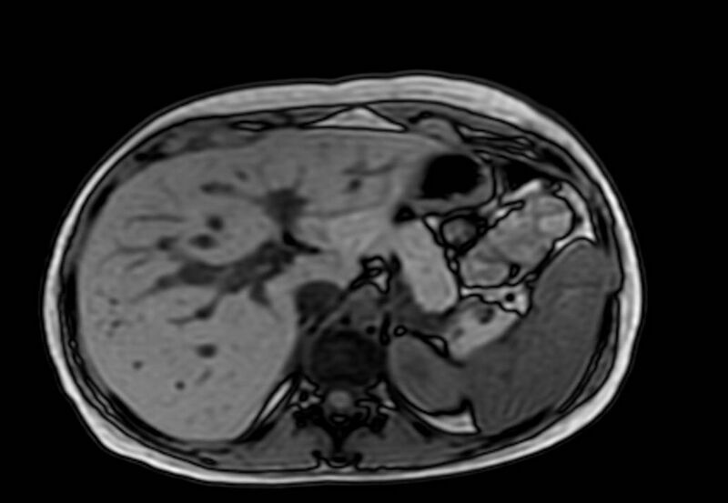 File:Appendicitis in gravida (MRI) (Radiopaedia 89433-106395 D 12).jpg