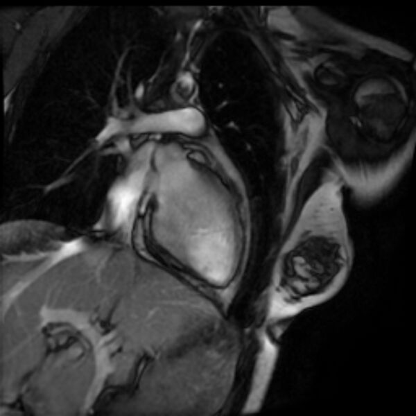 File:Arrhythmogenic right ventricular cardiomyopathy (Radiopaedia 87505-103850 2ch (LV) Cine SSFP 19).jpg