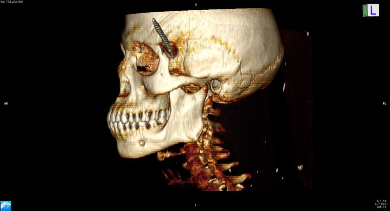 File:Arrow injury to the head (Radiopaedia 75266-86388 3D horizontal 16).jpg