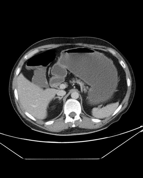 File:Arterial occlusive mesenteric ischemia (Radiopaedia 84641-100054 A 33).jpg