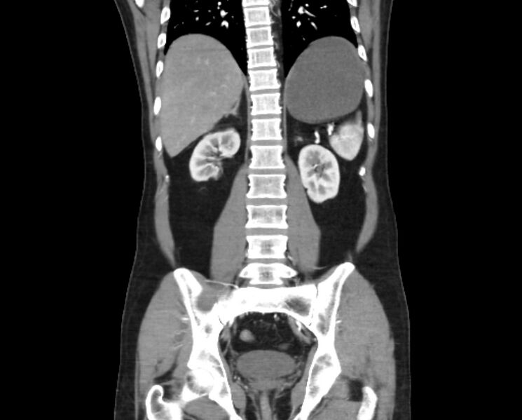File:Arterial occlusive mesenteric ischemia (Radiopaedia 84641-100060 B 38).jpg