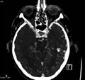 Arteriovenous malformation - cerebral (Radiopaedia 8172-14682 A 6).jpg